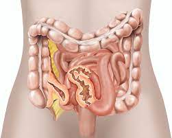 Read more about the article Crohn’s Disease Complications