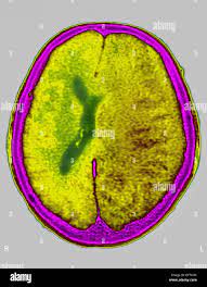 You are currently viewing What Is Cerebral Edema? Symptoms, Causes, Diagnosis, Treatment, and Prevention